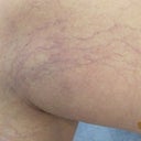 Leg Veins