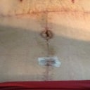 Swollen!!! Pic evening after drains pulled. Bb looks like a heart from my view lol