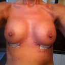 four days post-op