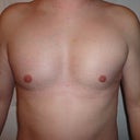 9 days post op (my right pec is still a bit more swollen than the left)