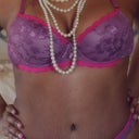 20 WEEKS POST OPT! See my tiger stripes? RAWR! But 360 degrees better than before!