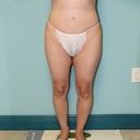 pre op front