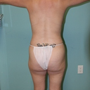 pre op back