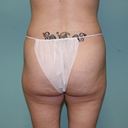 pre op butt