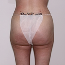 post op butt