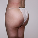 post op left