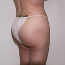post op right