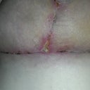 Concerned about the t-junction incision. Infected?