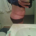 This is what it looks like when I bend over . . . not very attractive & it's uncomfortable (before surgery)