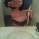 The other side view of when I bend over (before surgery)