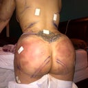 Post op 2nd Day
