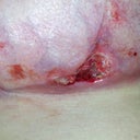 3 wks 2days  The day the PS removed the dead tissue from my T-junction separation on right breast.
