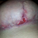 3 wks 5days Right breast separation