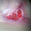 3 wks 5days Right breast separation