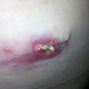 3 wks 5days Left side separation under armpit (where the drain tube was located).