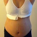 1 day post op front view with surgical bra.
3/9/2012