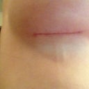 Look closely and you can see the 2 cords that showed up under my right boob. I can feel some on my left, too, but not as prominent. :(