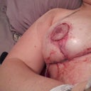 2 hours after surgery