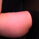 Right upper arm, 1 week prior to the procedure/