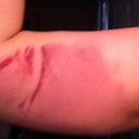 Post op day 2, 24 hours after procedure.