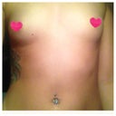 The difference in both breast can clearly be seen. I hope that can be fixed