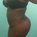 3 months post op