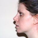1 year 8 months post-op.