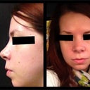 2 weeks post-op