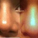 The left picture, was my first rhinoplasty with a gore-tex implant, and the right picture is my nose after it got infected by the gore-tex implant.