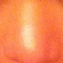 This is my second rhinoplasty and how my nose turned out, 6 months after the plastic surgeon removed my infected implant.