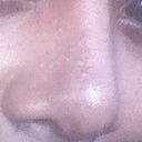 This was my third rhinoplasty, the plastic surgeon replaced the implant with ear cartilage, which I loved how it looked after the splint was removed.