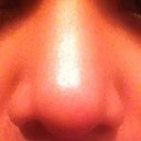 And this is my nose now, 3 months after surgery, flat again. It seems like the ear cartilage is gone and the tip is huge again =( The tip and the bridge don't look refined like how it did after the splint got removed. =( I asked If my nose will look like it was after I got my splint removed and the assistant said that probably not, but that my nose looks good now, which I highly doubt.