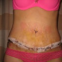 Post Op Day 8- Drains out!