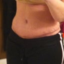 4 weeks post op