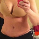 4 weeks post op