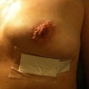 12 days: my troublesome left breast