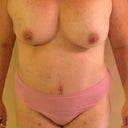 1 month post op front