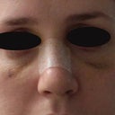 After splint removal (6 days post op)- front view