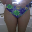 1 week post-op/thighs. No bruising on the front!