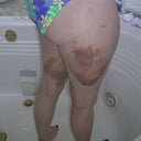 1 week post-op/thighs