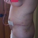 Now that's whath I'm talkin' 'bout!! bye-bye hematoma!