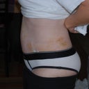 Post Op Day 6 Side