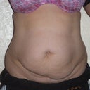 front view pre op