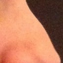 Right side before (worst side) - bulbous nostril and dorsal hump