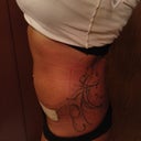 Post op week 2  very swollen