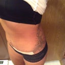 Post op week 2 very swollen