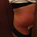Post op day week 2