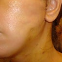 facelift dimpling/ dents
