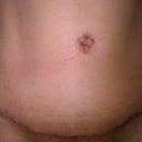 25 days after revision and before silicone treatment.