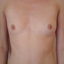 Before surgery